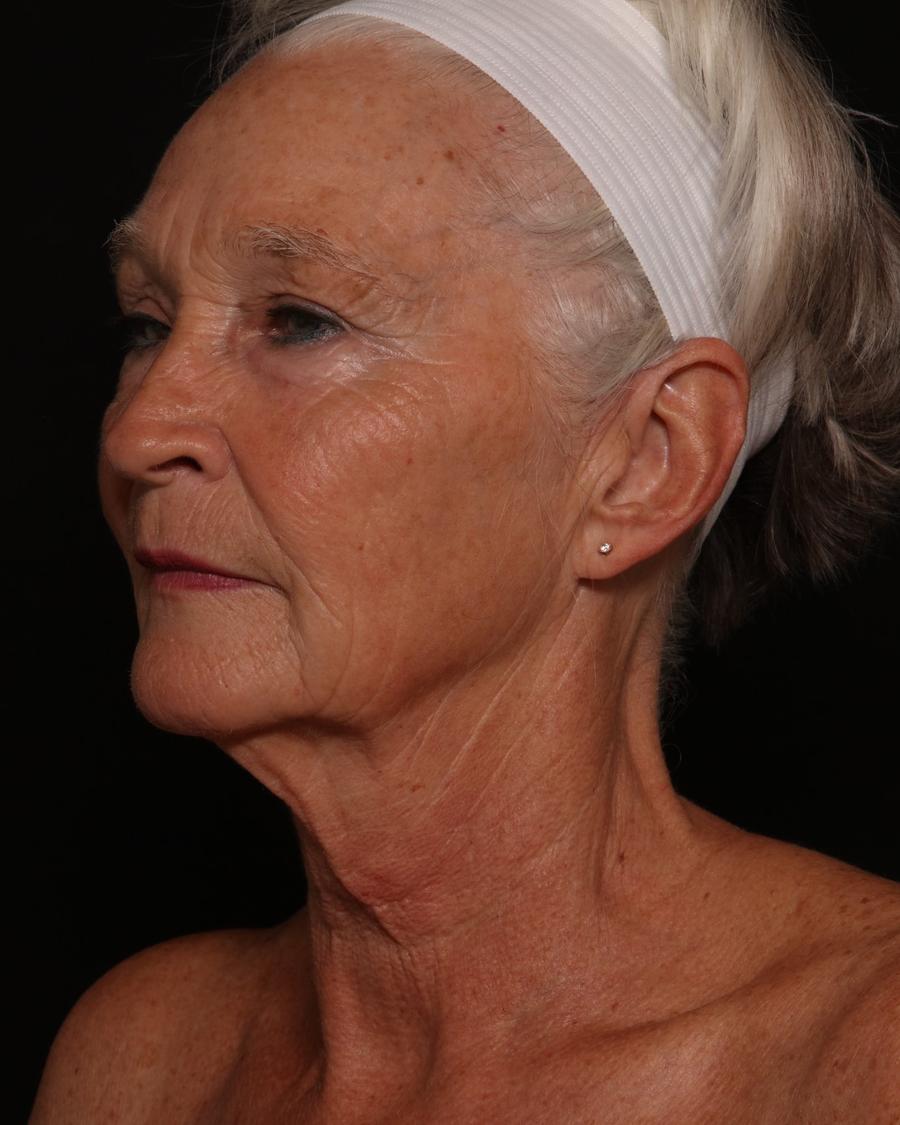 Facelift (neck lift included), view 4, before