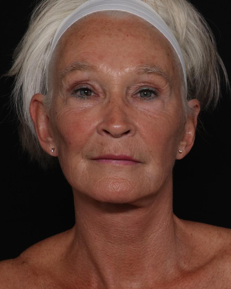 Facelift (neck lift included) after