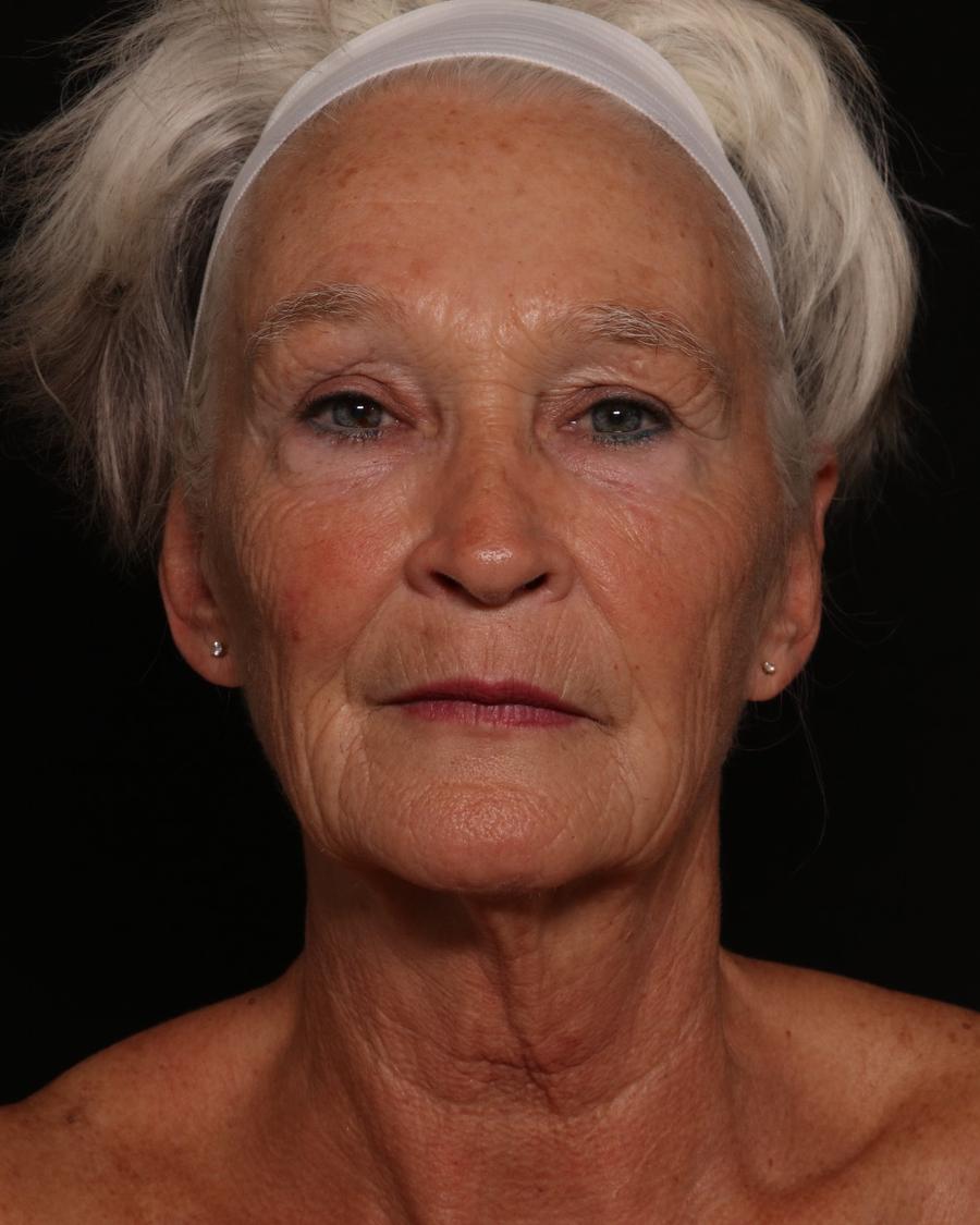 Facelift (neck lift included) before