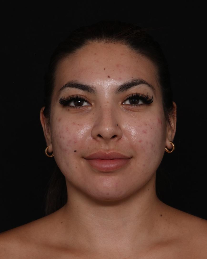 Neck Liposuction w/ Magic Tight after