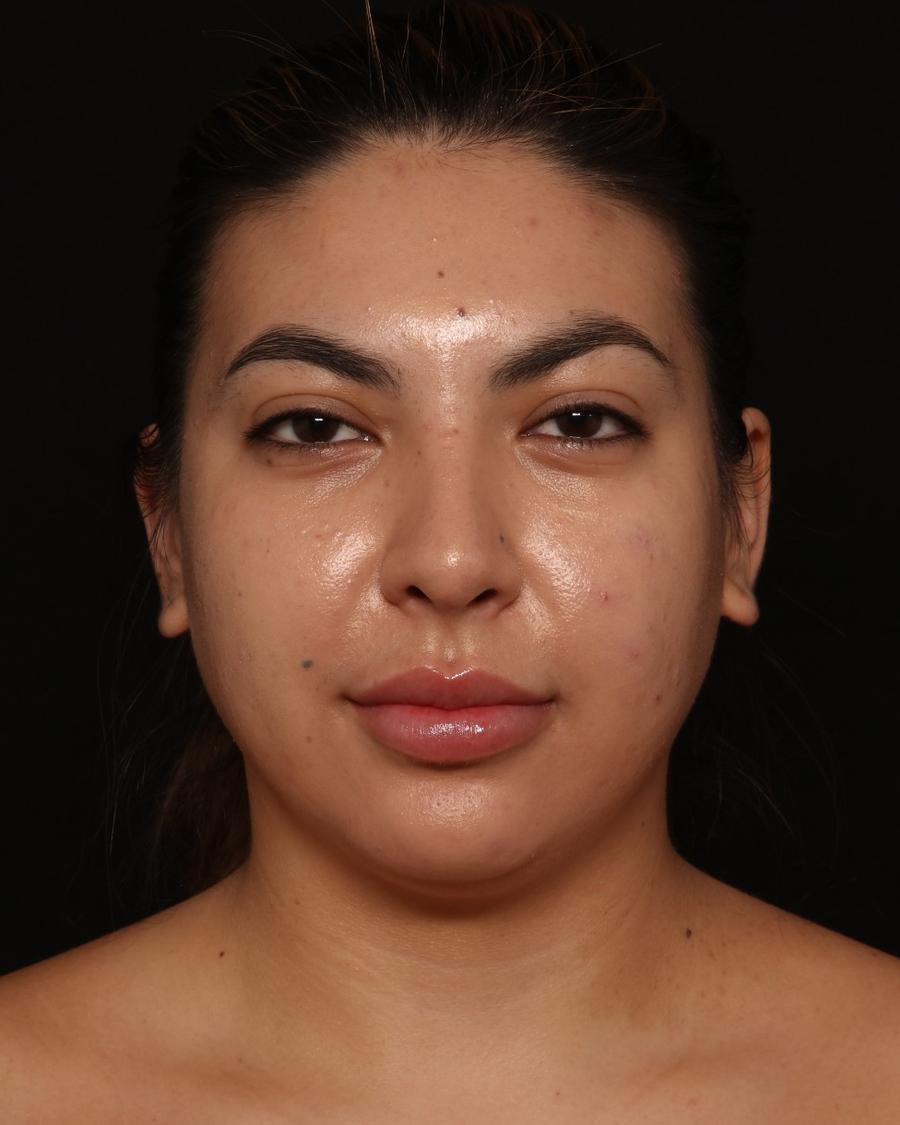 Neck Liposuction w/ Magic Tight before