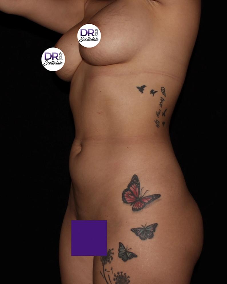 Vaser Lipo 360 (5L Max) before