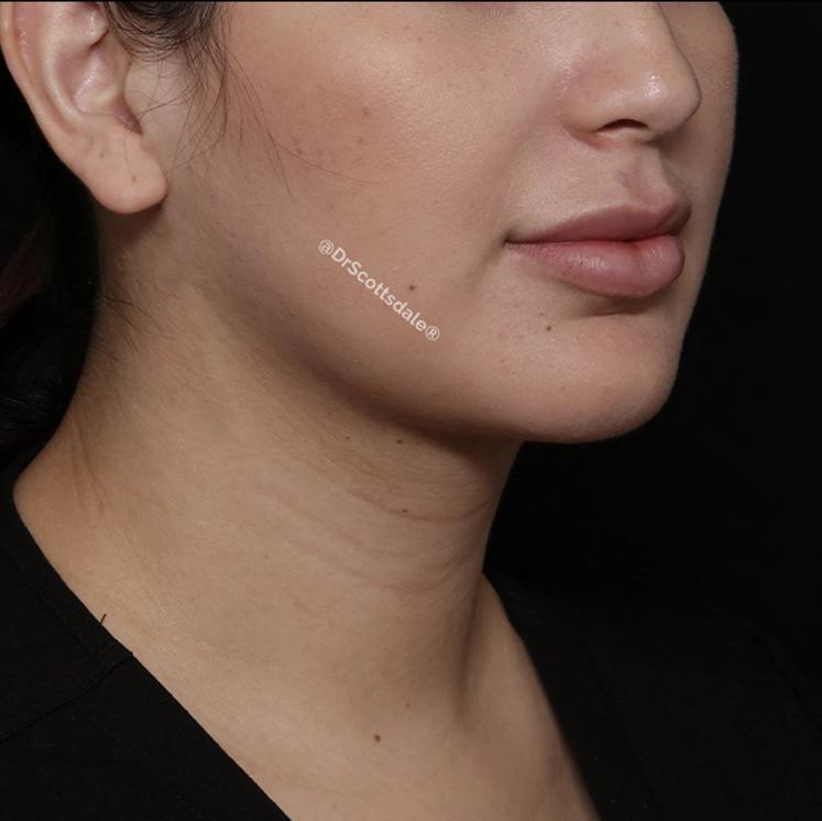 Neck Liposuction w/ Magic Tight after