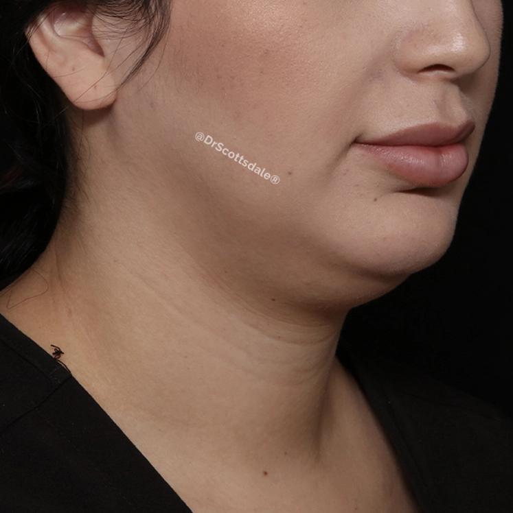 Neck Liposuction w/ Magic Tight before