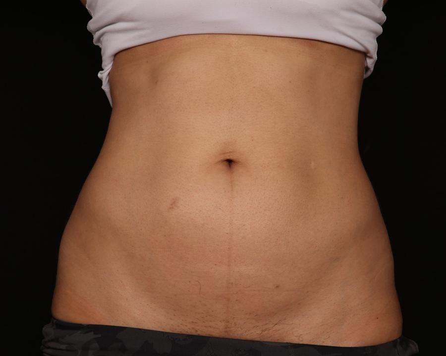 Emsculpt Neo after