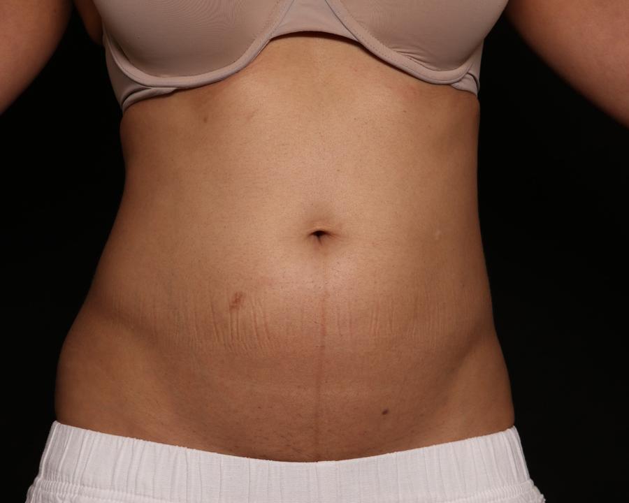 Emsculpt Neo before