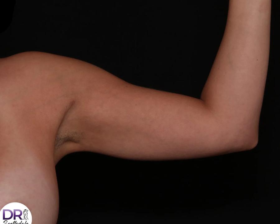 Arm Lift after