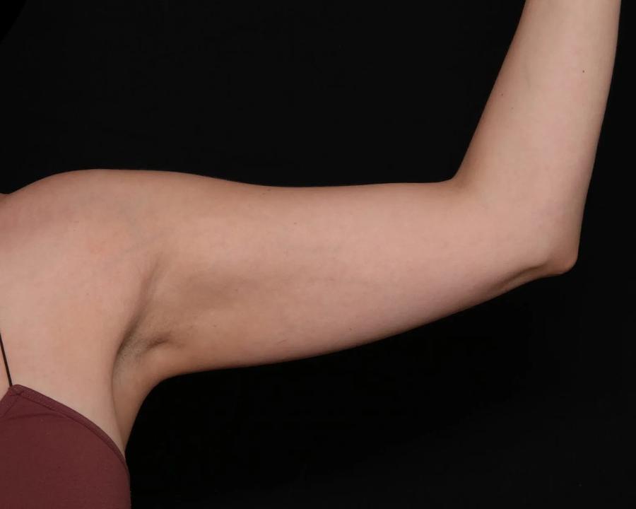 Arm Lift before