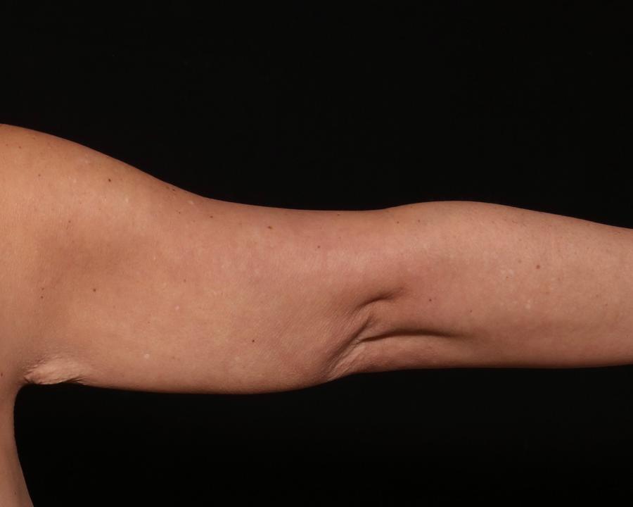 Arm Liposuction w/ Magic Tight after