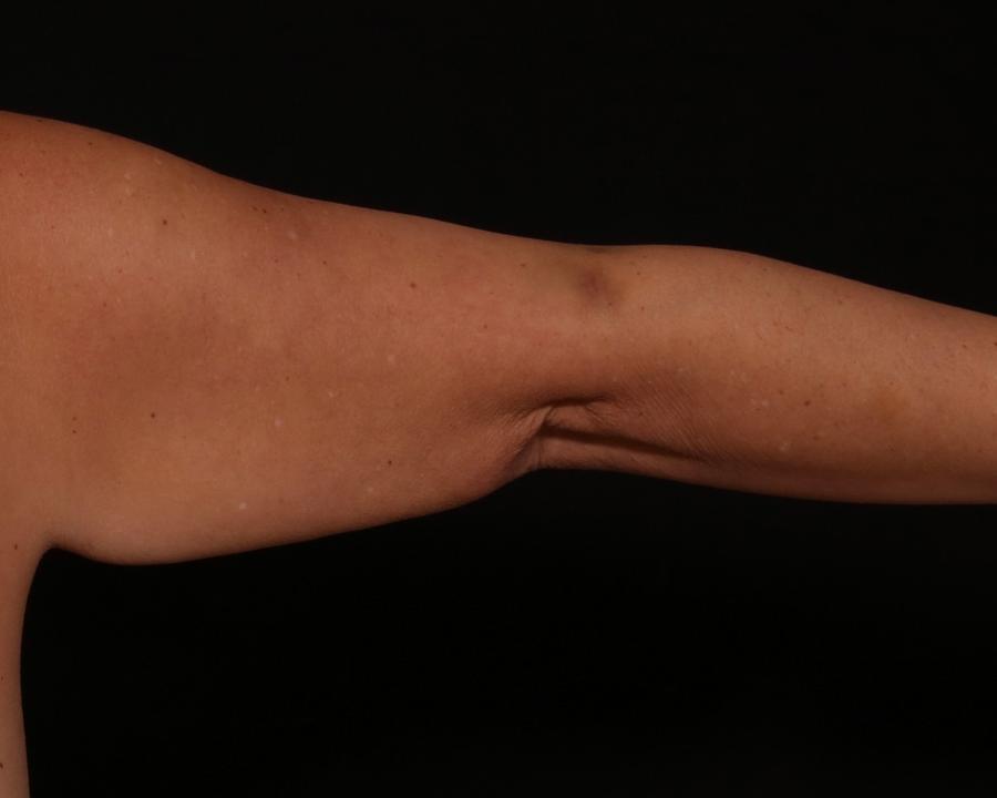 Arm Liposuction w/ Magic Tight before