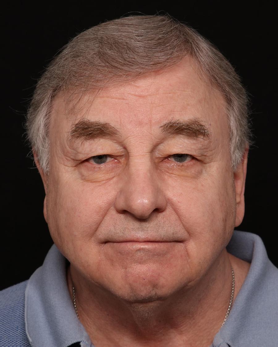 Facelift before