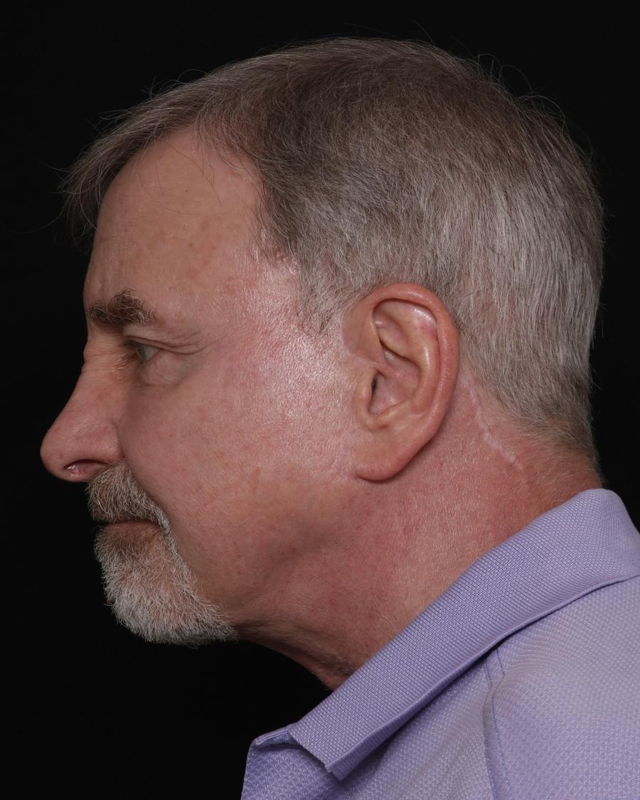 Facelift, view 3, after