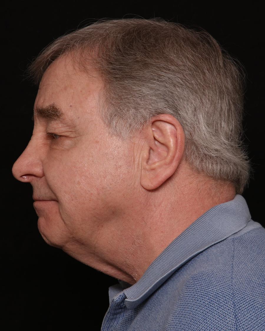 Facelift, view 3, before