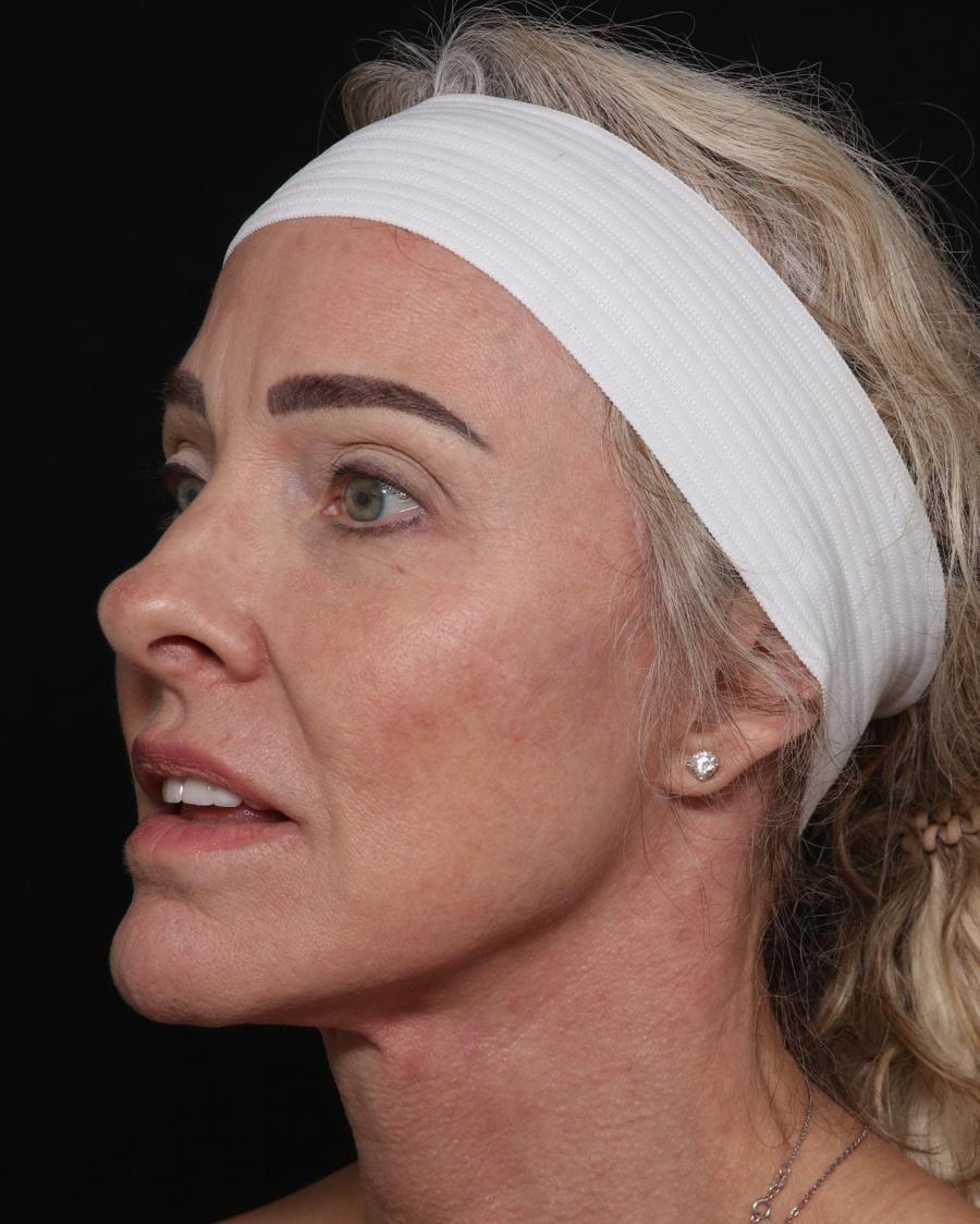 Facelift (neck lift included) after