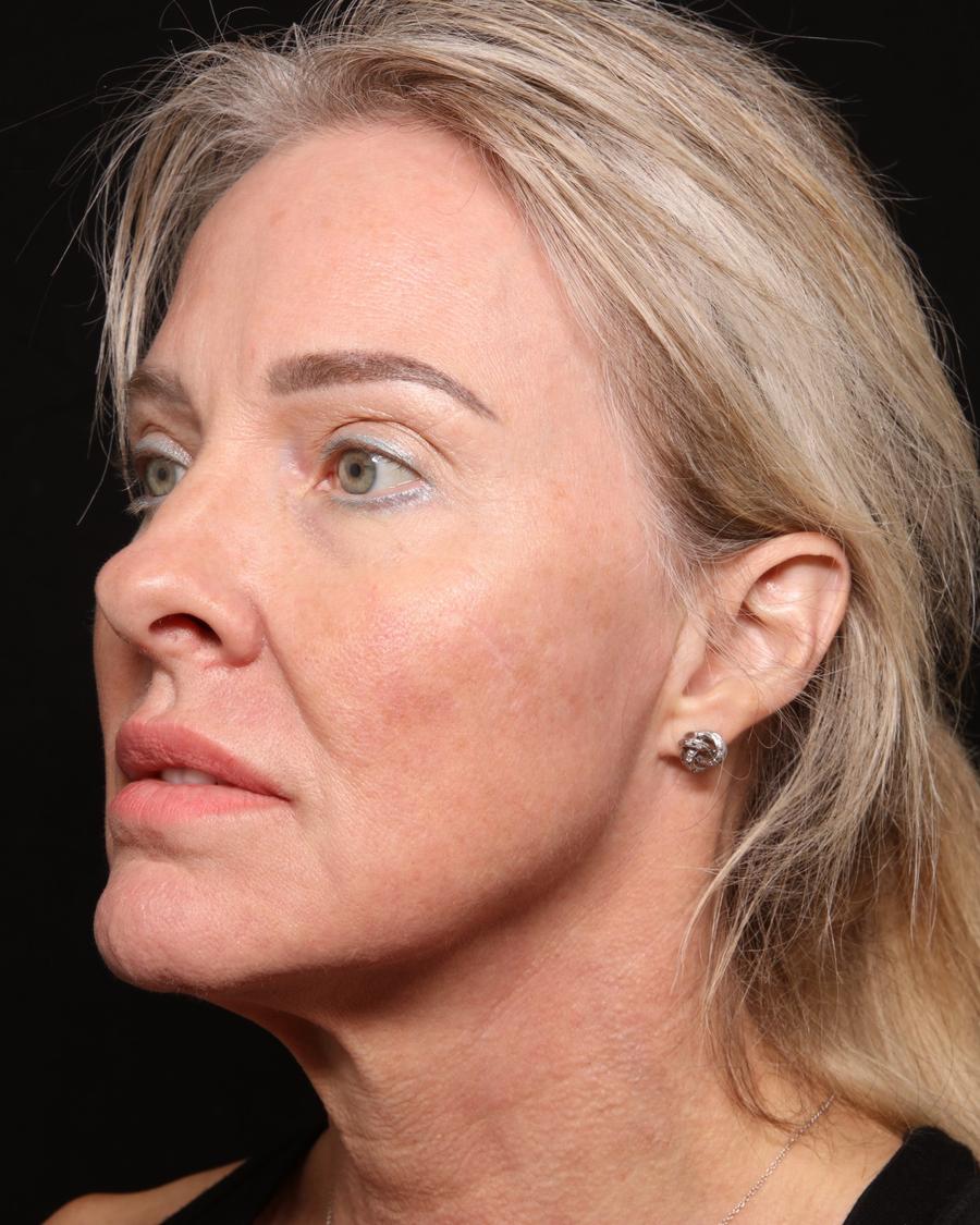 Facelift (neck lift included) before
