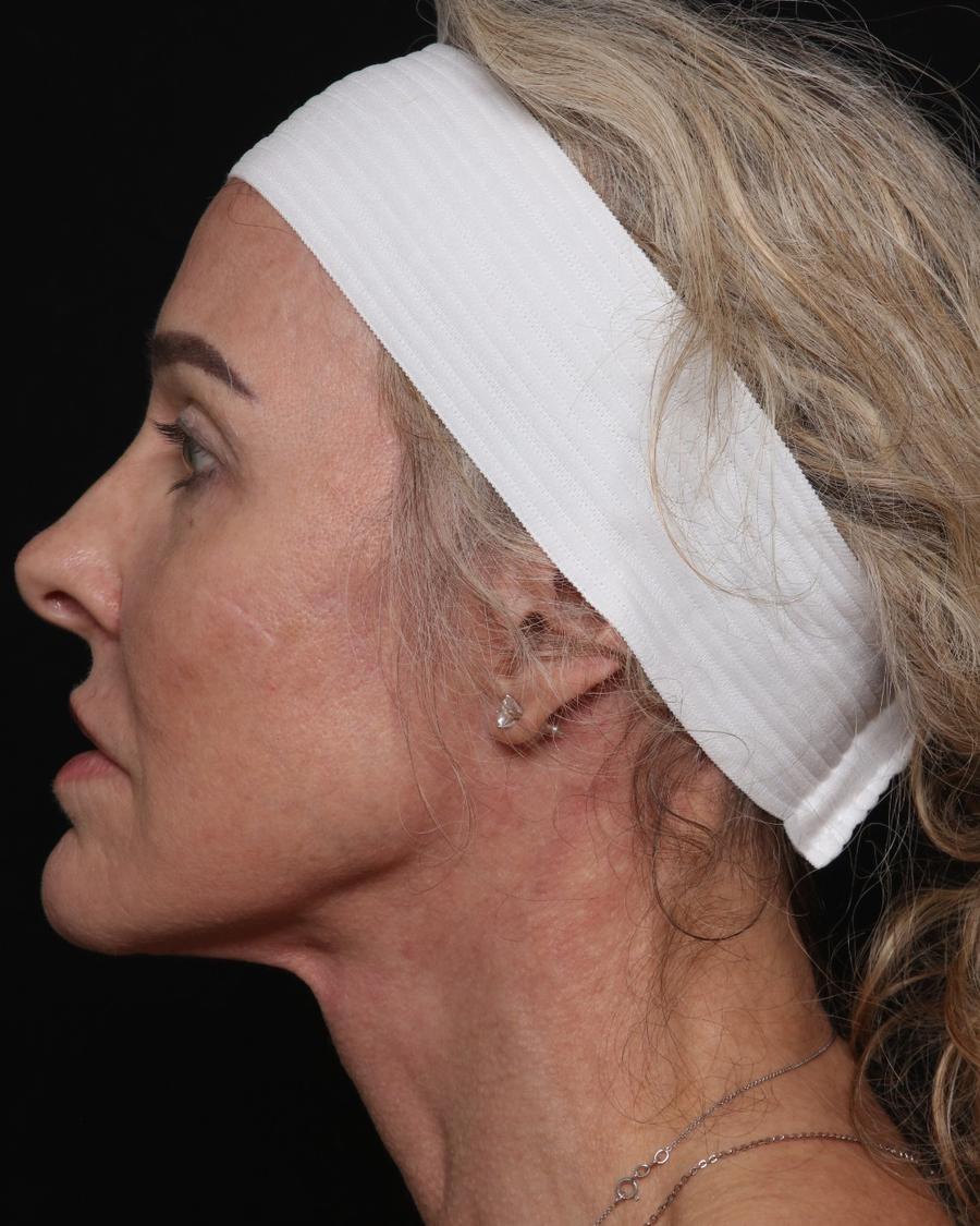 Facelift (neck lift included), view 3, after