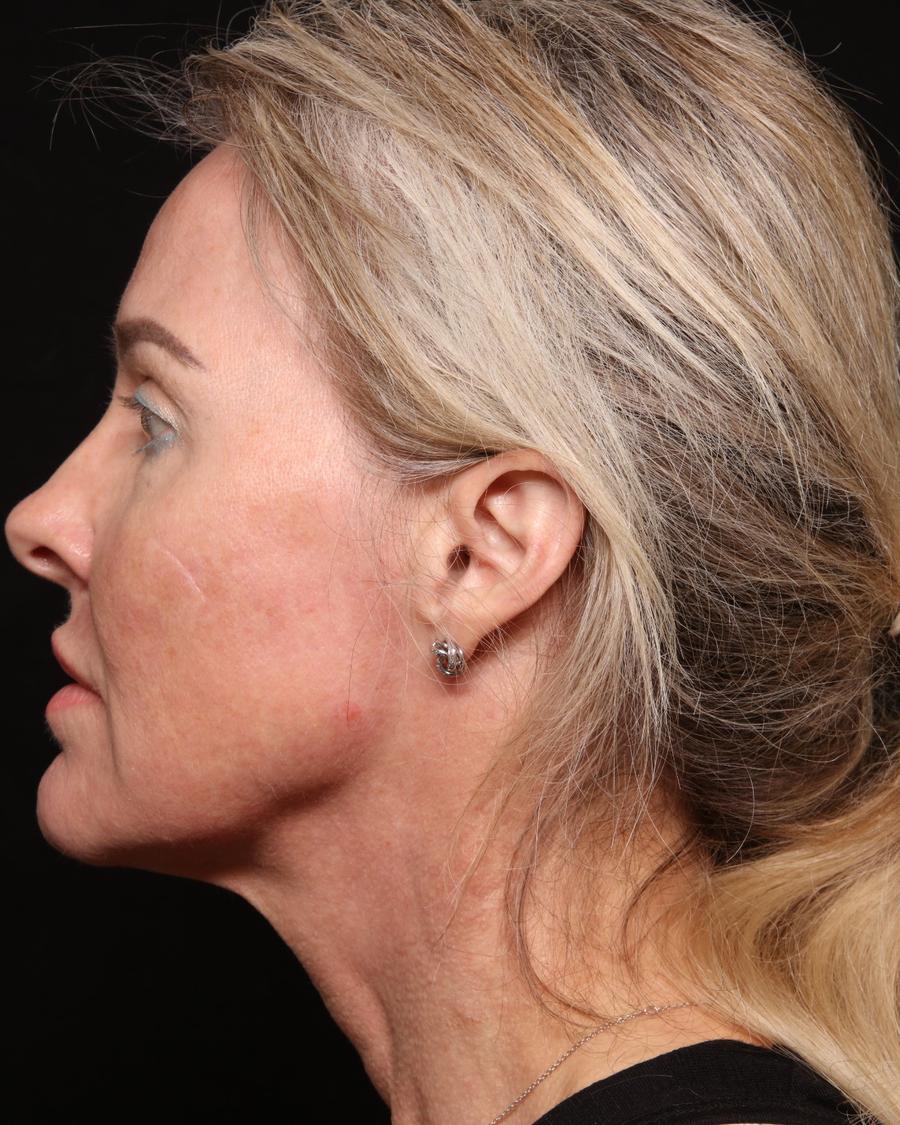 Facelift (neck lift included), view 3, before