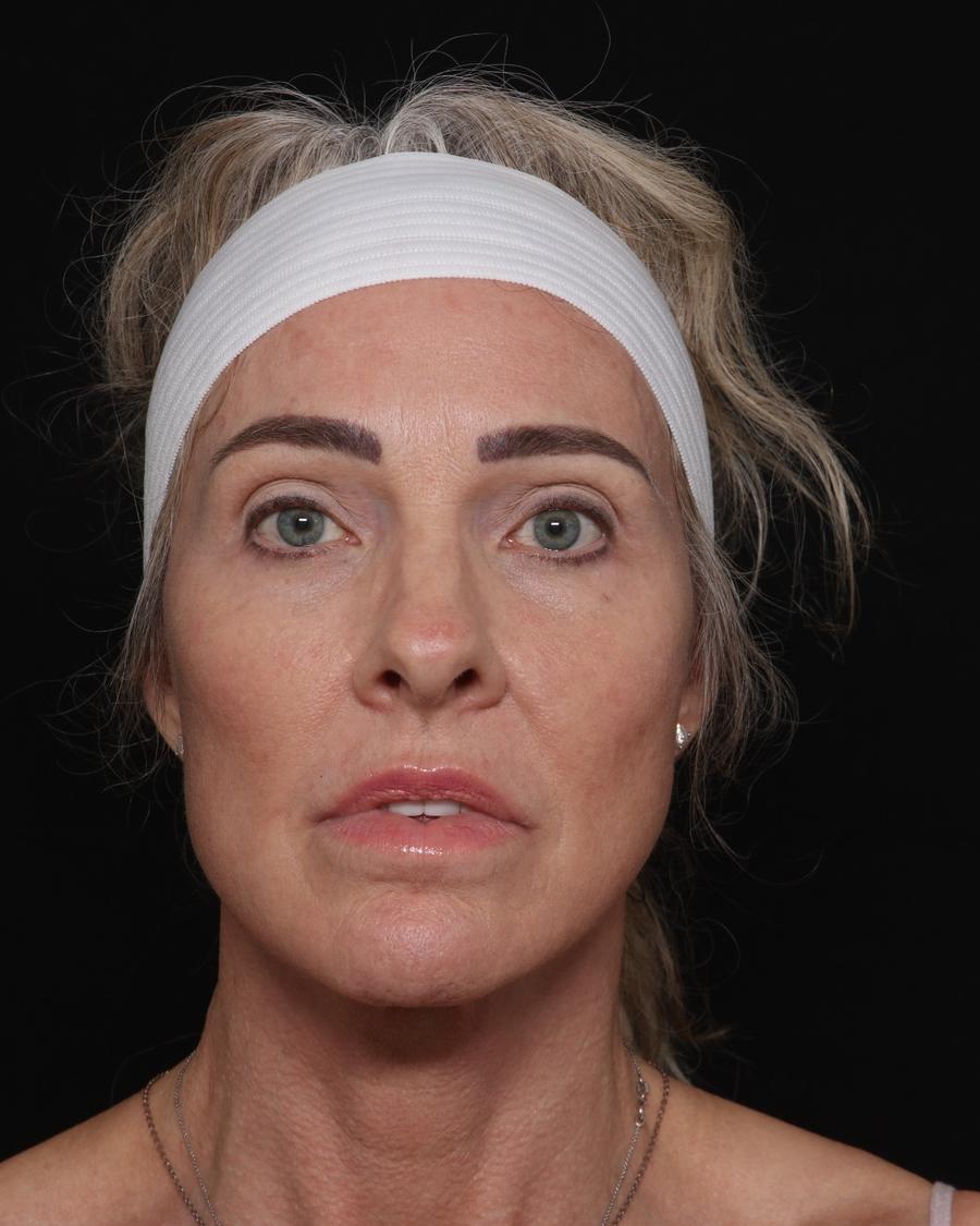 Facelift (neck lift included), view 2, after