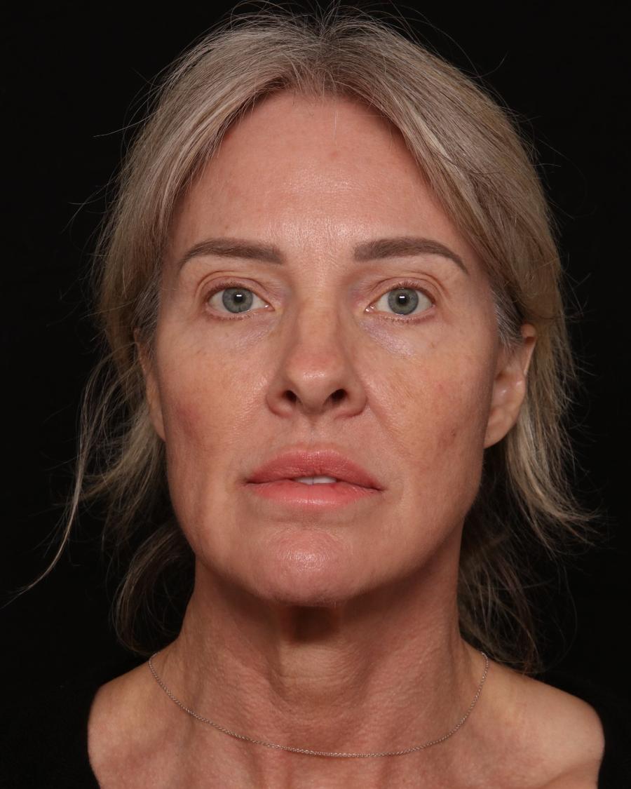 Facelift (neck lift included), view 2, before
