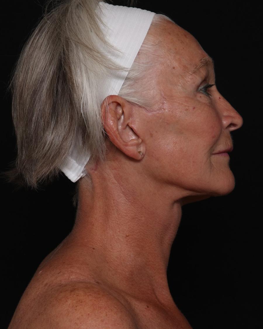 Facelift (neck lift included), view 2, after
