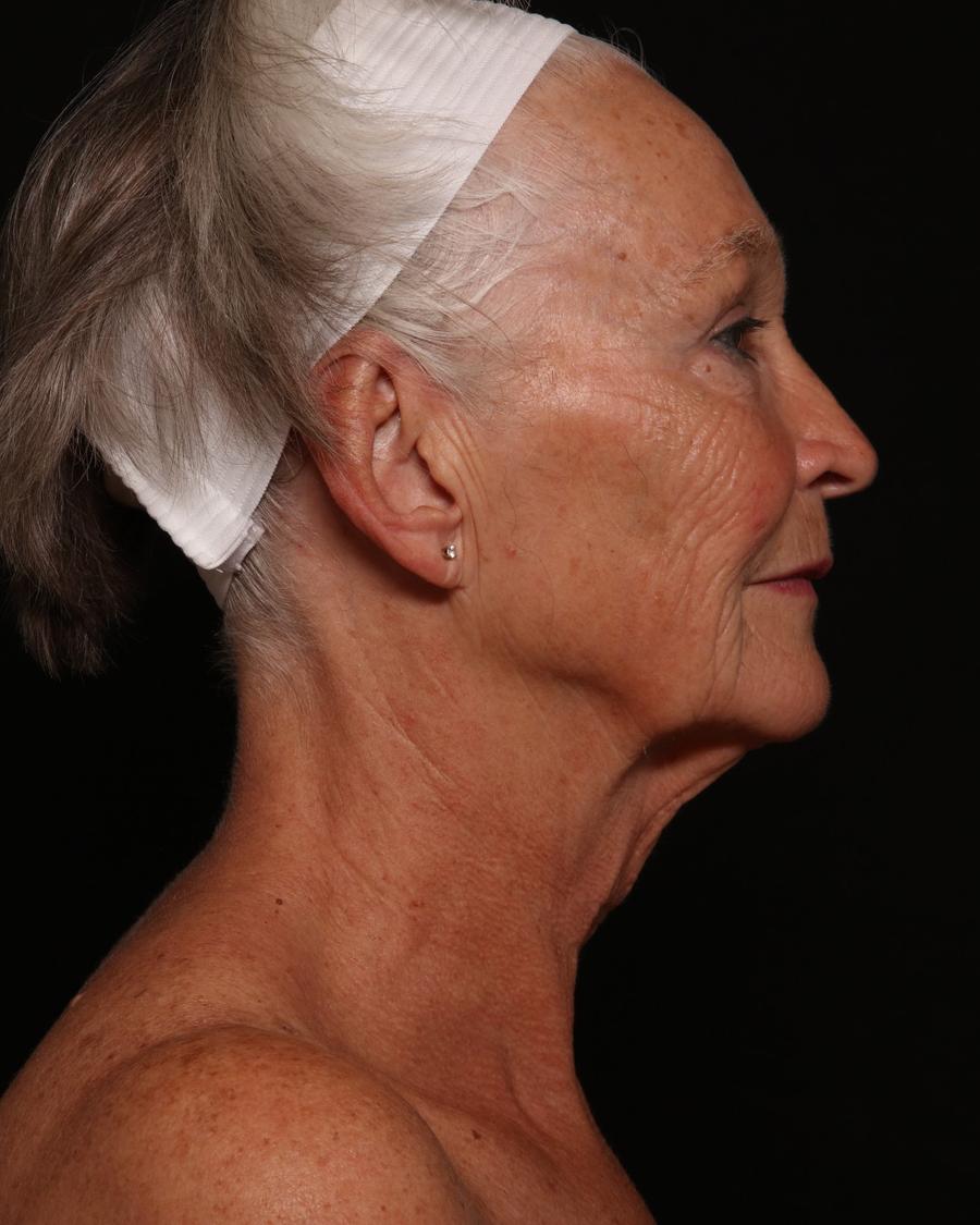 Facelift (neck lift included), view 2, before