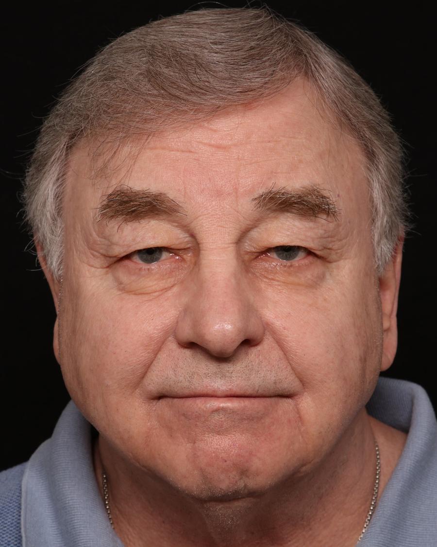 Facelift, view 2, before