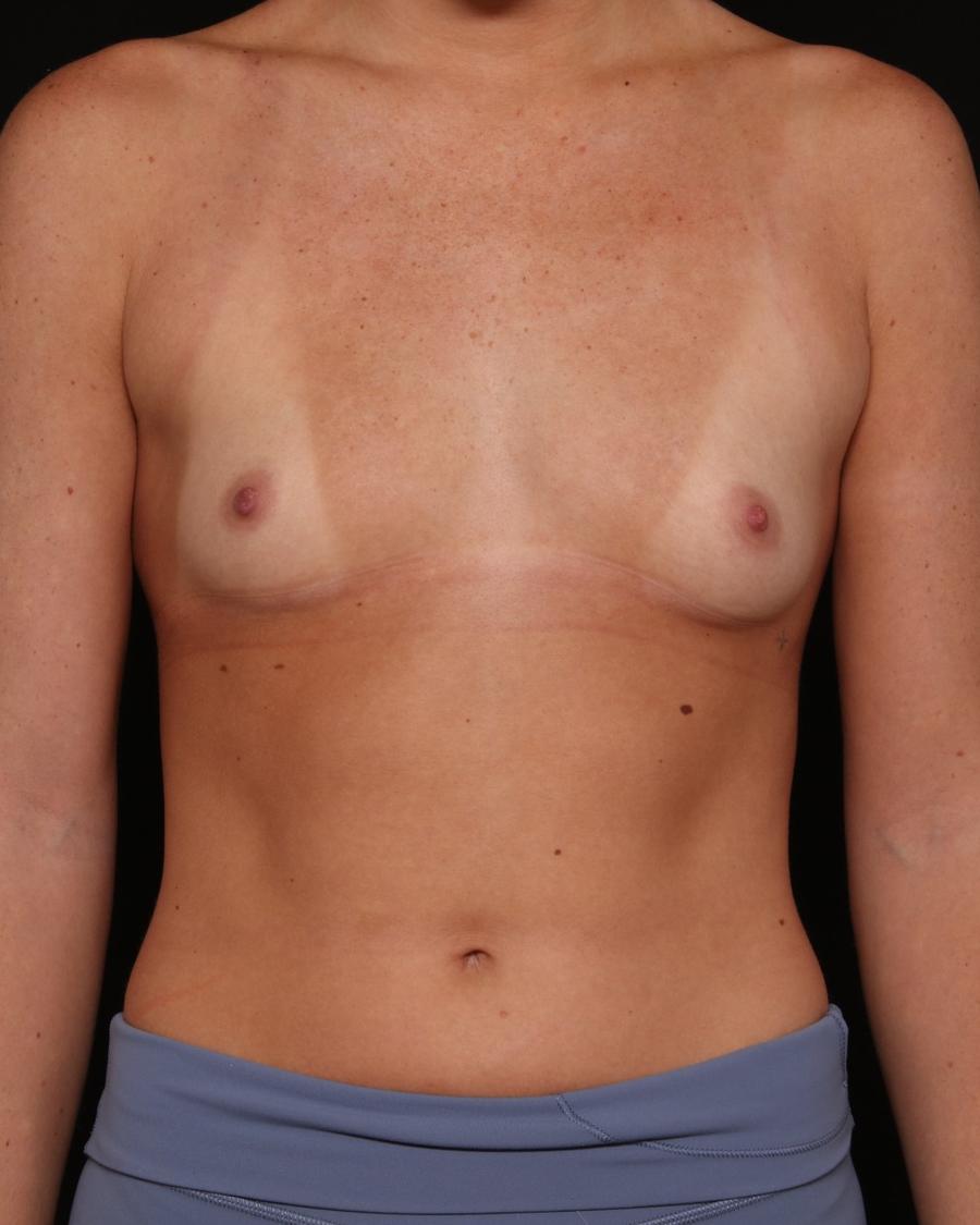 Breast Augmentation with Preservé before