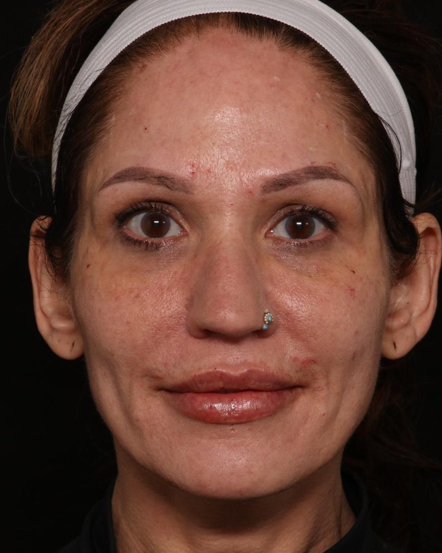 Ellacor before