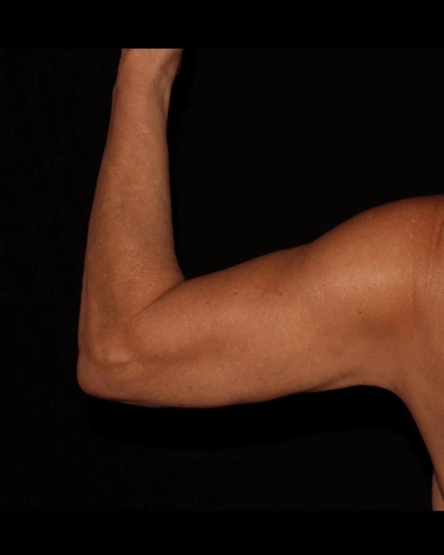 Arm Lift, Back view, after