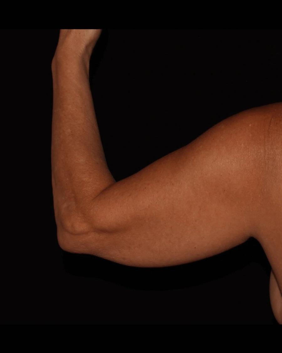 Arm Lift, Back view, before