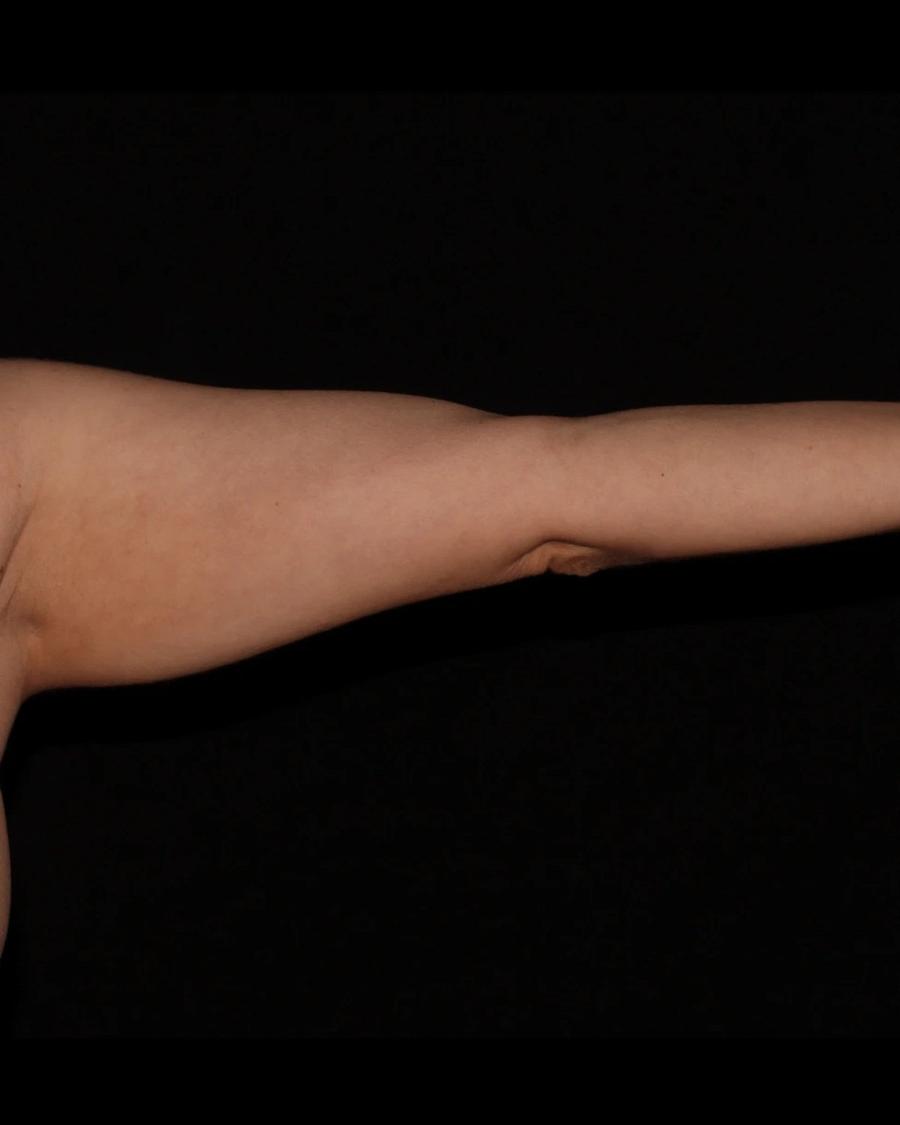 Arm Lift before