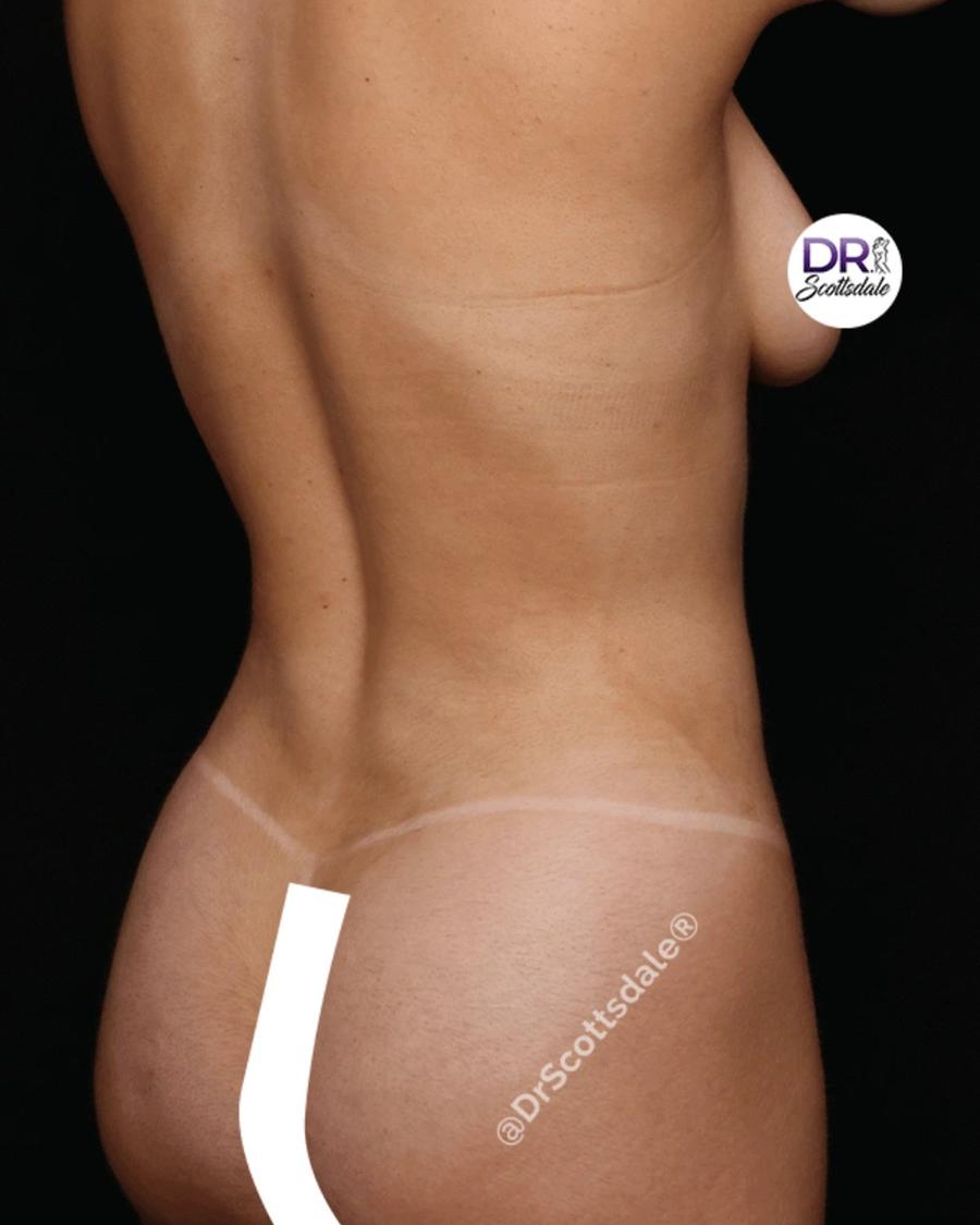 Vaser Lipo 360 (5L Max), Right Profile view, after