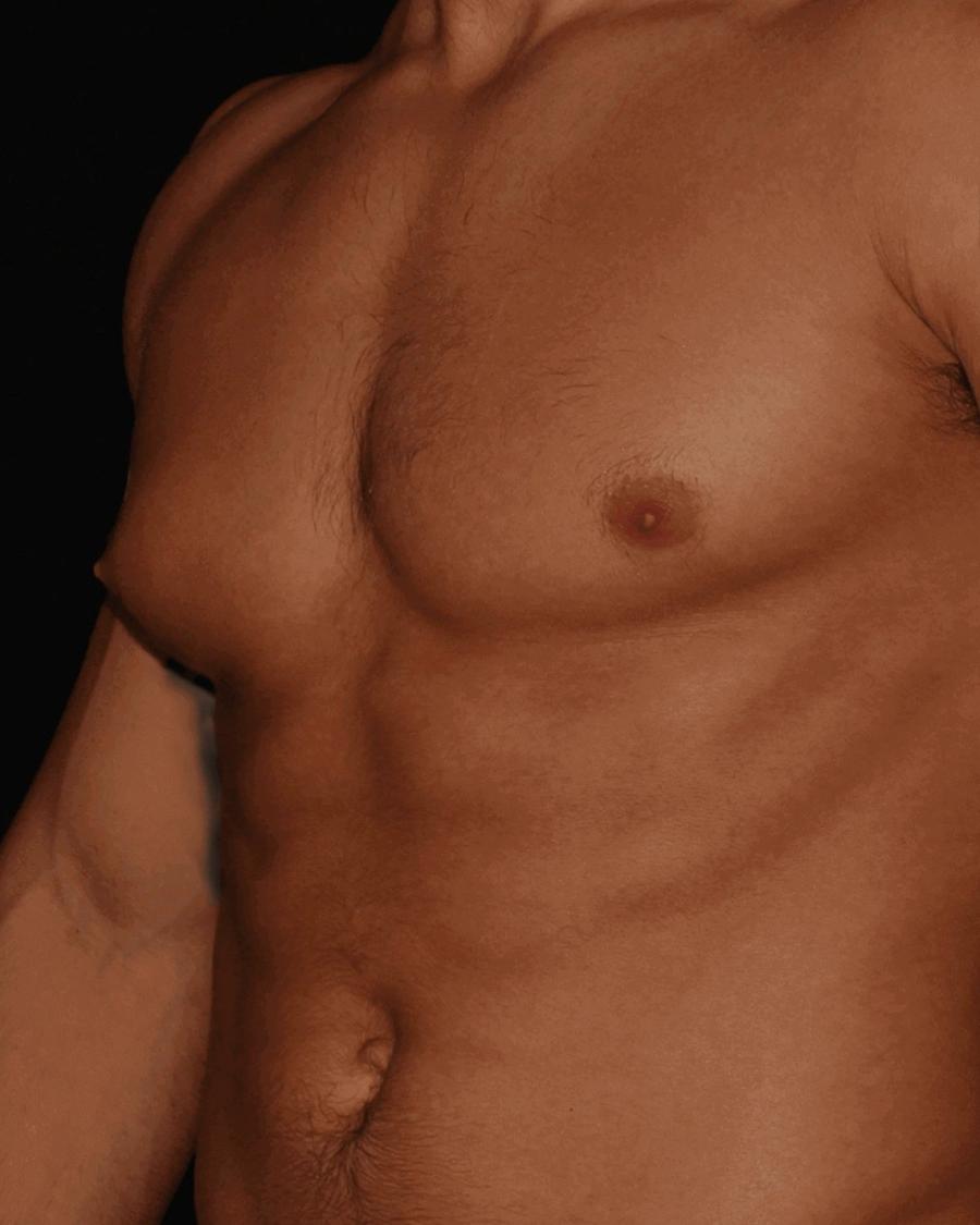 One-Stitch Gynecomastia before