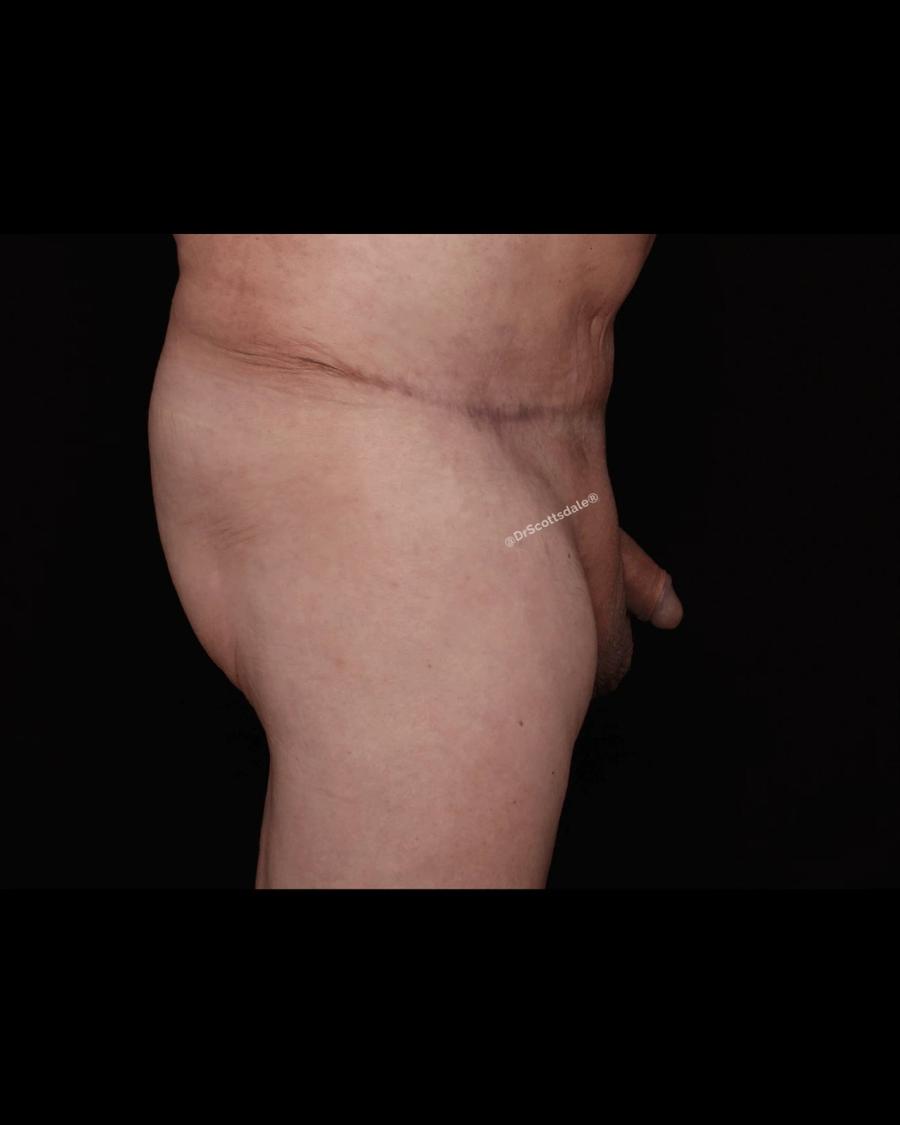 Penis Filler, Right Profile view, after