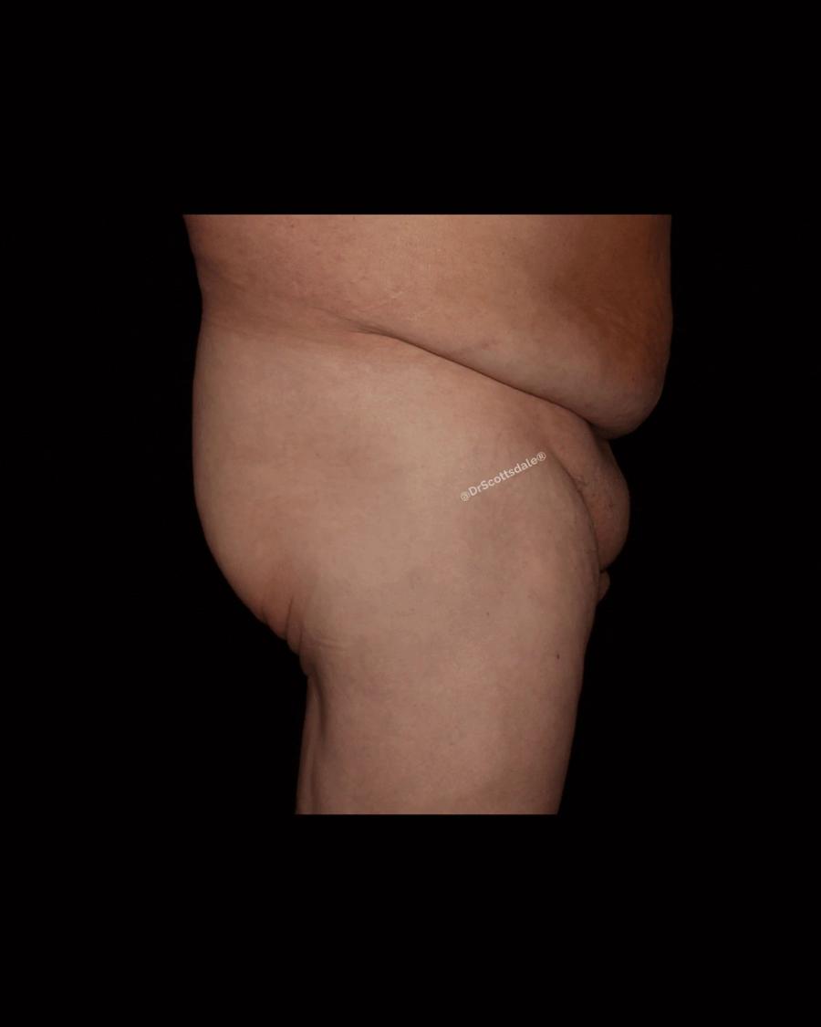 Penis Filler, Right Profile view, before