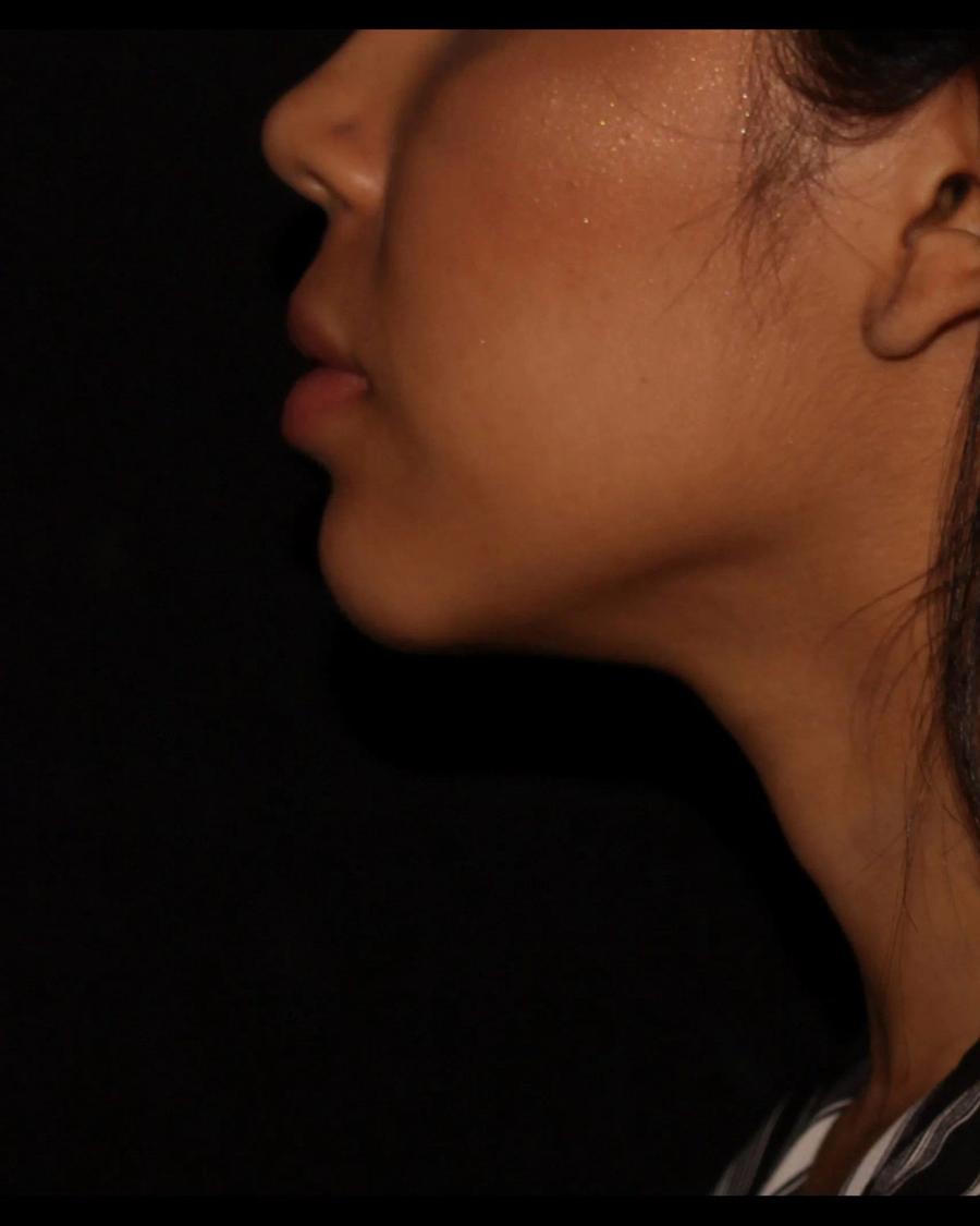 Buccal Fat Pad Removal, Right Profile view, after