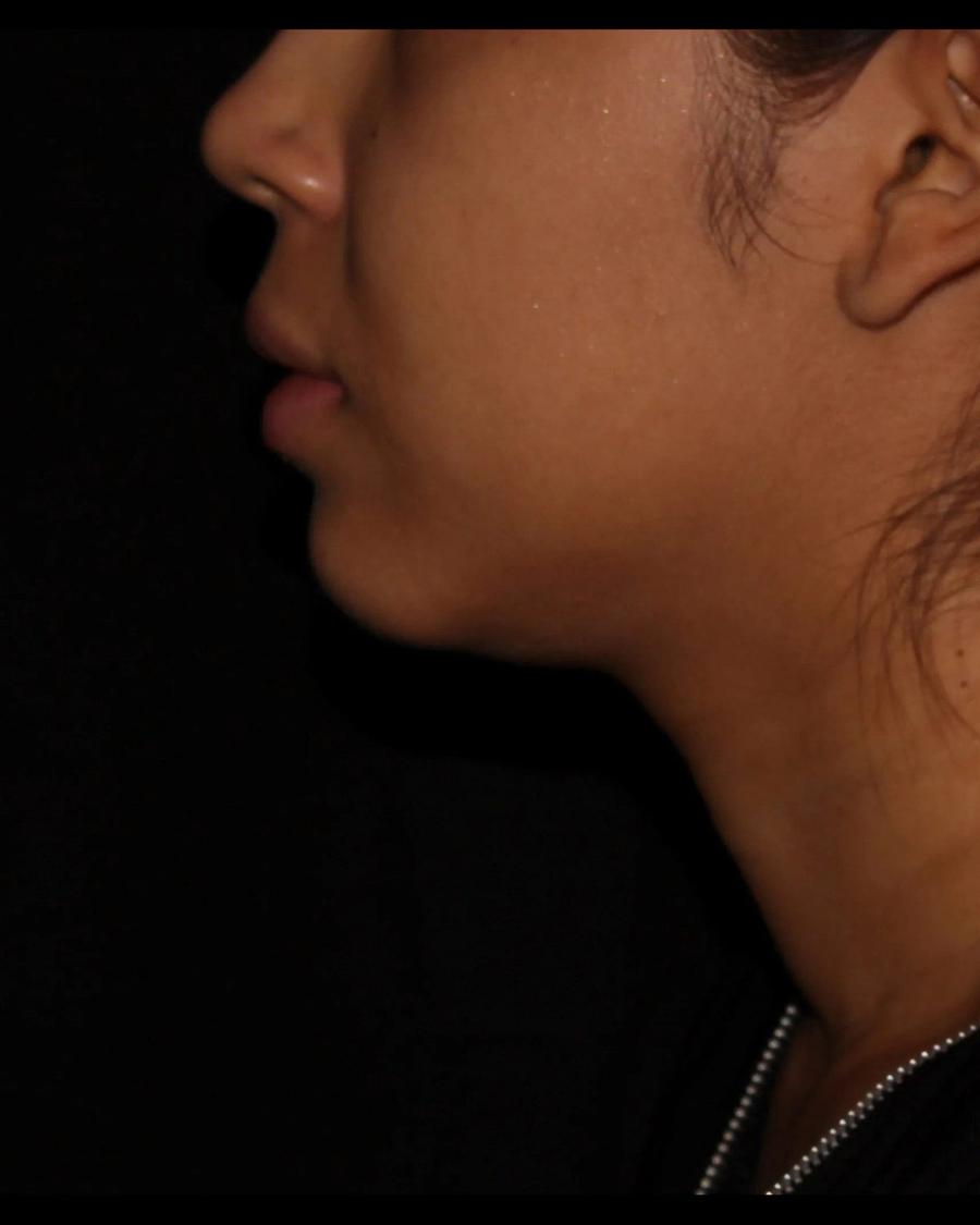 Buccal Fat Pad Removal, Right Profile view, before