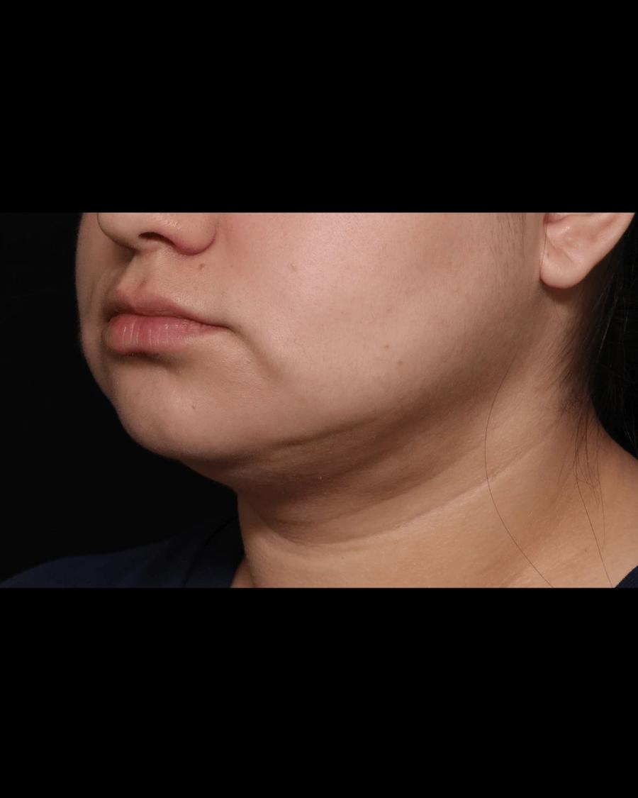Buccal Fat Pad Removal, Oblique Right view, after