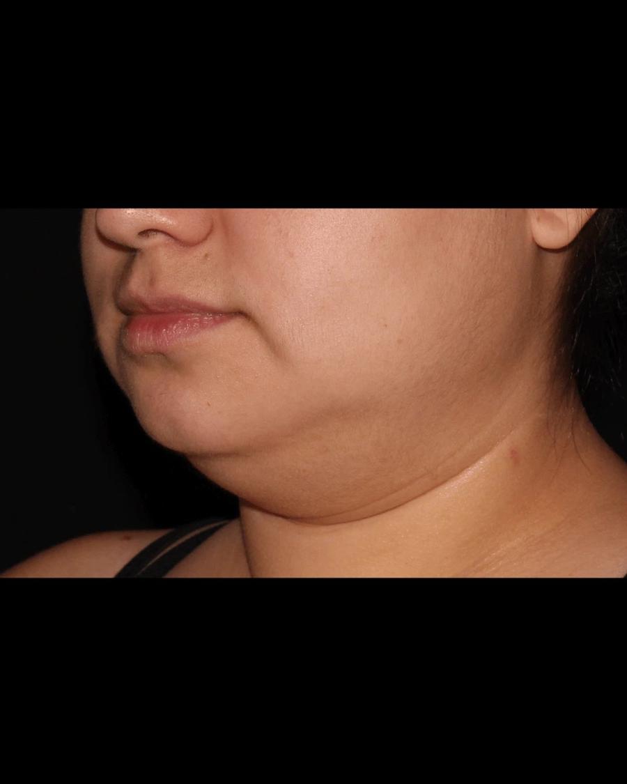 Buccal Fat Pad Removal, Oblique Right view, before
