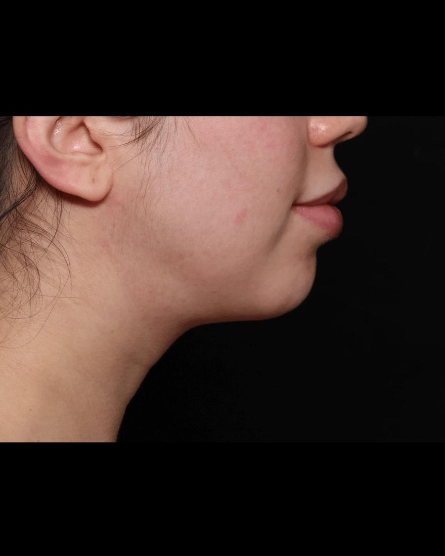 Buccal Fat Pad Removal, Oblique Right view, after