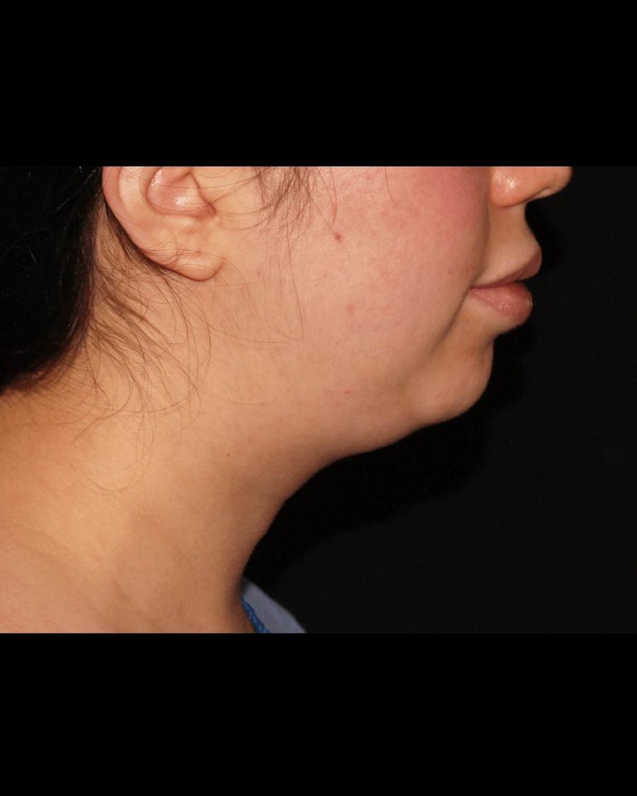 Buccal Fat Pad Removal, Oblique Right view, before