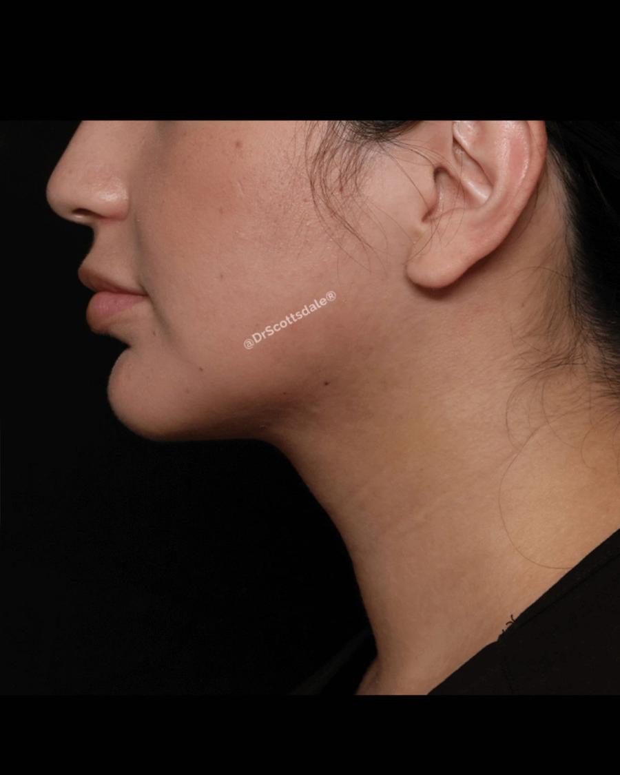 Neck Liposuction w/ Magic Tight, Right Profile view, after