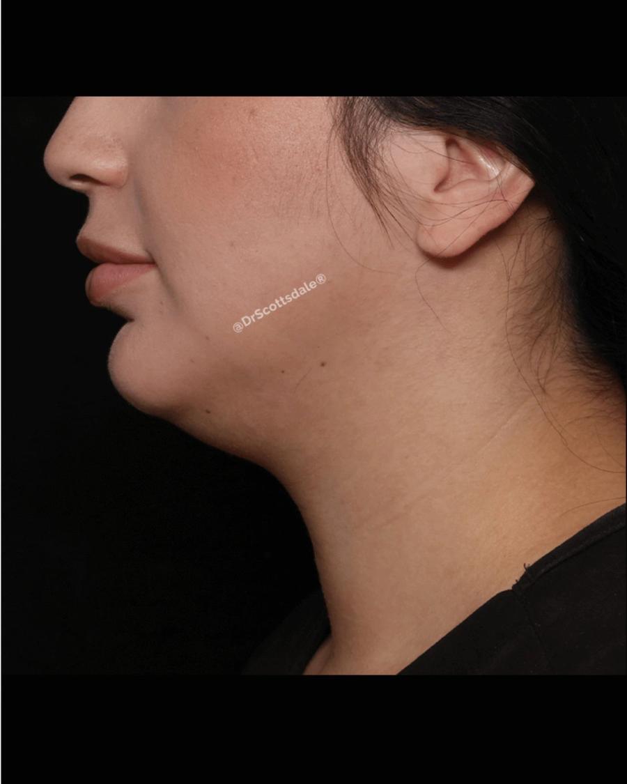 Neck Liposuction w/ Magic Tight, Right Profile view, before