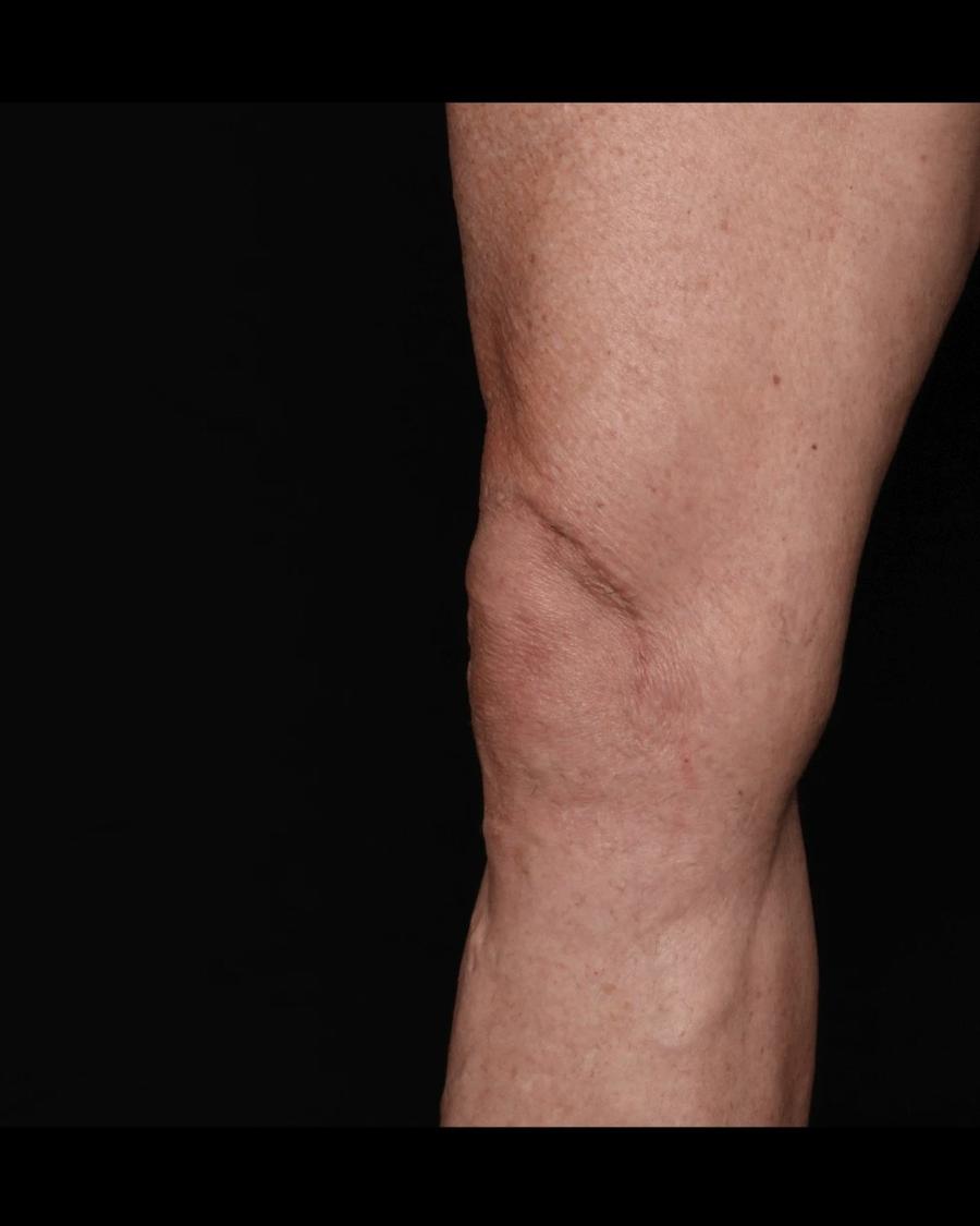 Thigh Lift (Medial), Right Profile view, after