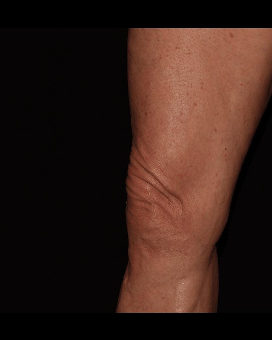 Thigh Lift (Medial), Right Profile view, before