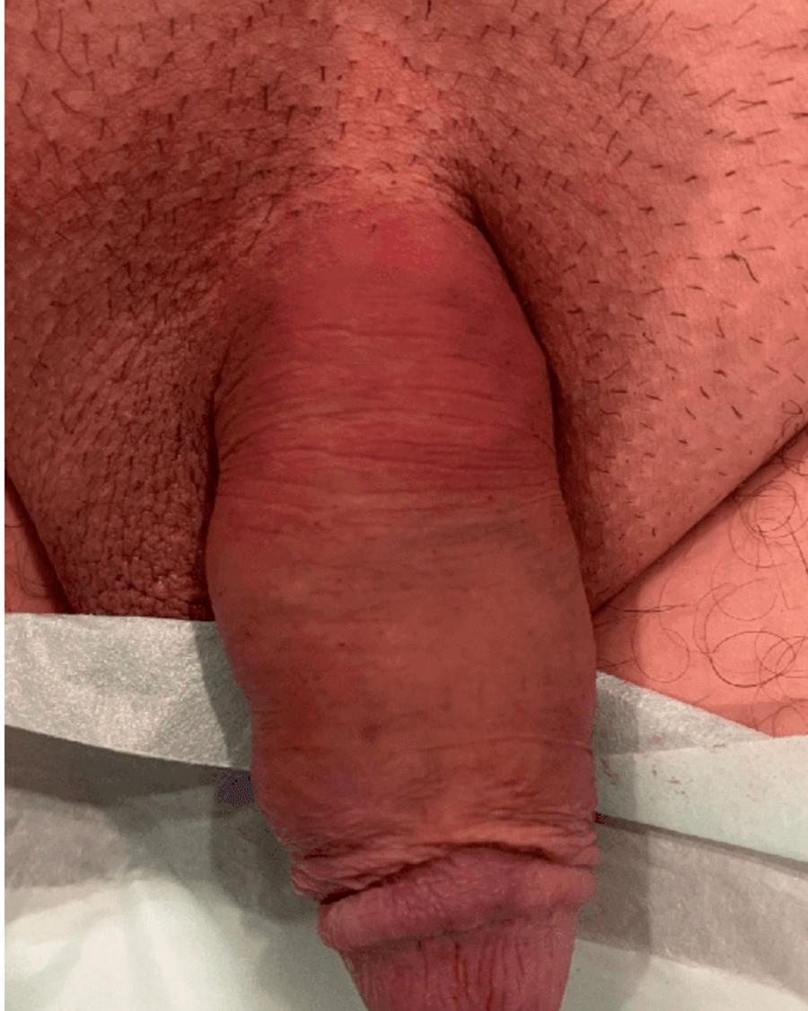 Penis Filler after
