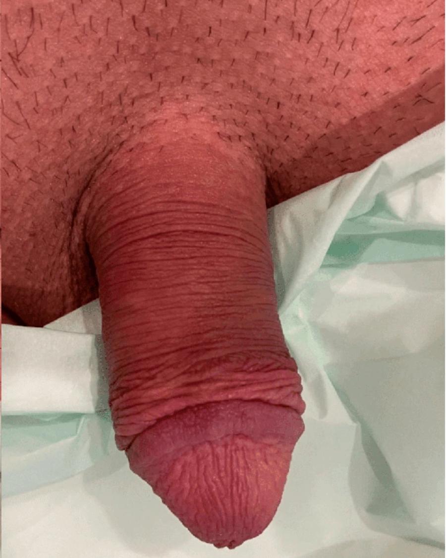Penis Filler before