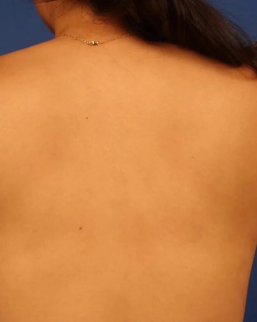 Arm Lift after