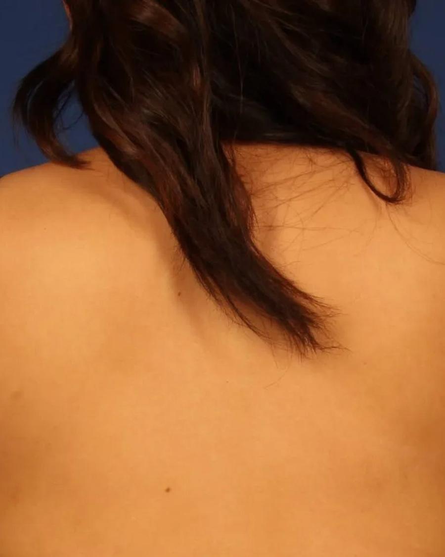 Arm Lift before