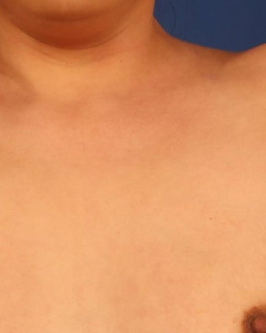 Arm Lift before